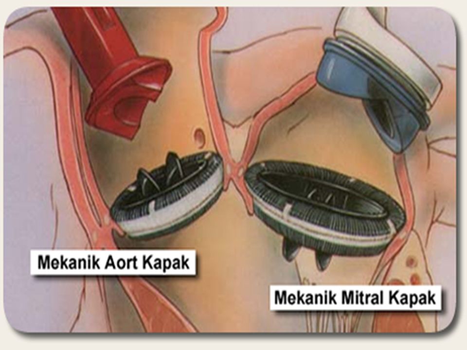 Aort Kapak Hastalıkları Nelerdir? Aort Yetmezliği Nedir?
